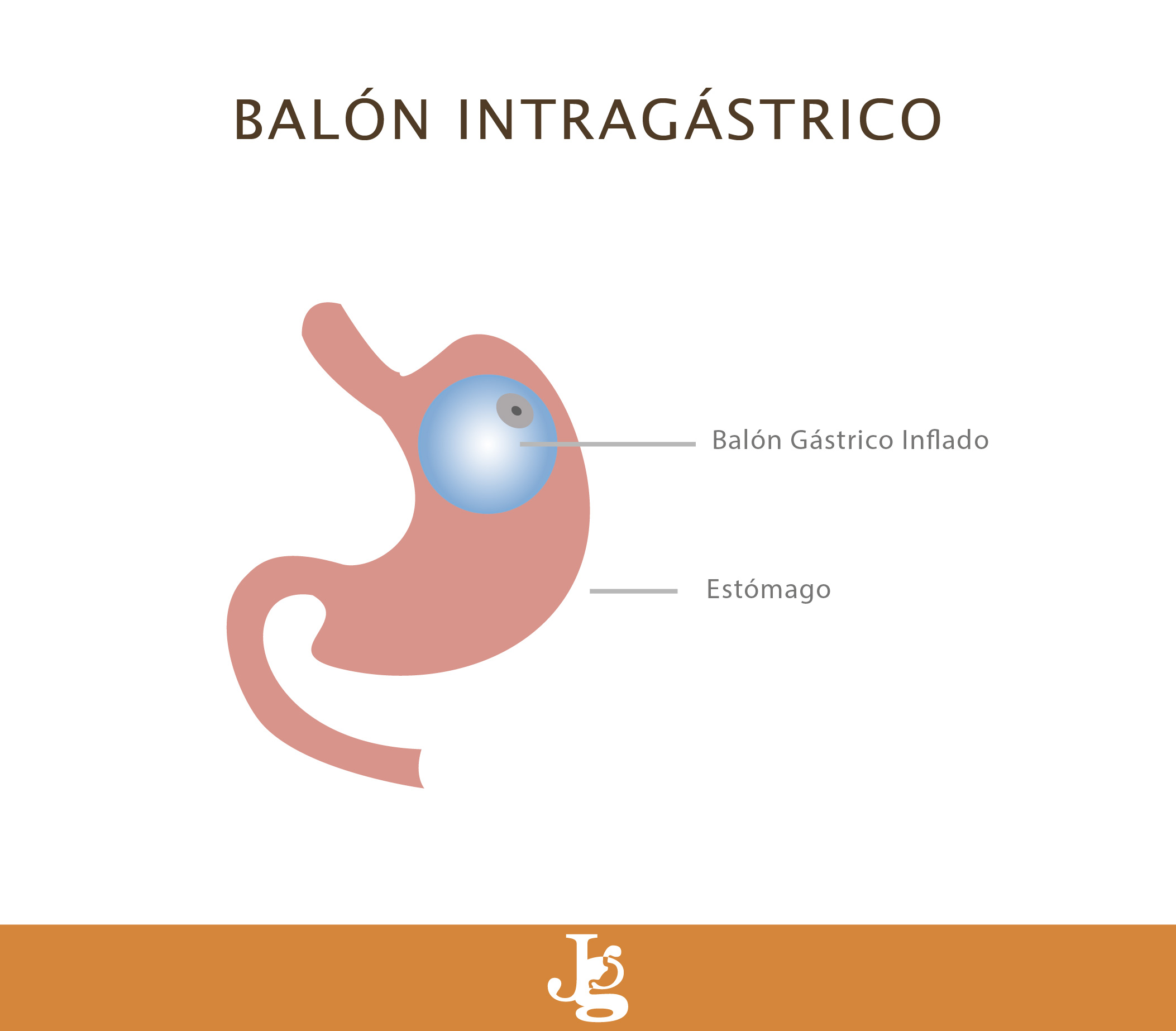 Diagrama Balon Gastrico