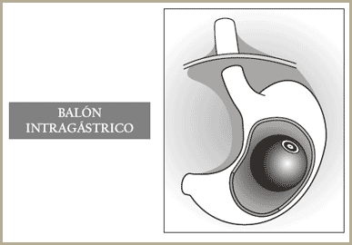 Balon gastrico