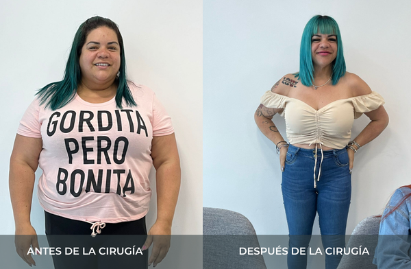 Antes y después de pérdida de peso tras cirugía bariátrica tipo sleeve en Medellín Juan Carlos Gongora