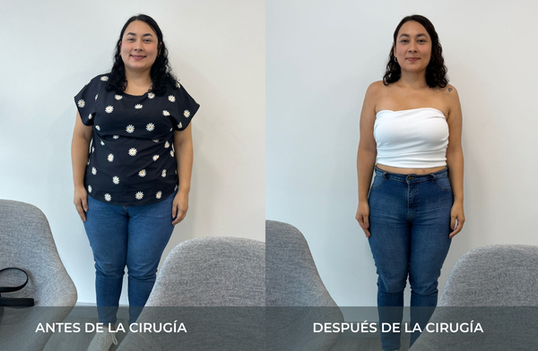 Antes y después de pérdida de peso tras cirugía bariátrica tipo sleeve en Medellín Juan Carlos Gongora