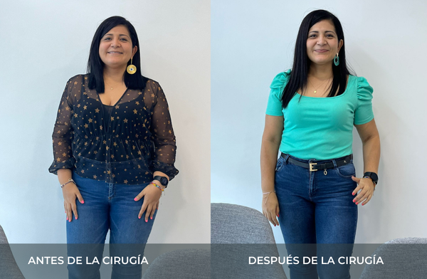 Antes y después de pérdida de peso tras cirugía bariátrica tipo sleeve en Medellín Juan Carlos Gongora