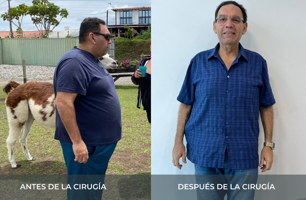 Antes y después de pérdida de peso tras cirugía bariátrica tipo sleeve en Medellín Juan Carlos Gongora