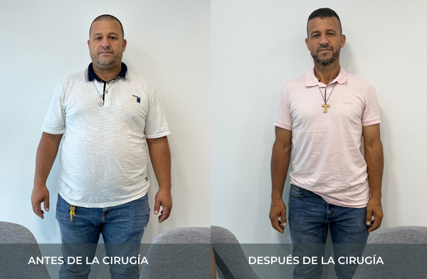 Antes y después de pérdida de peso tras cirugía bariátrica tipo sleeve en Medellín Juan Carlos Gongora