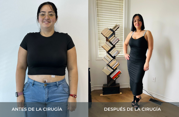 Antes y después de pérdida de peso tras cirugía bariátrica tipo sleeve en Medellín Juan Carlos Gongora