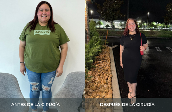 Antes y después de pérdida de peso tras cirugía bariátrica tipo sleeve en Medellín Juan Carlos Gongora