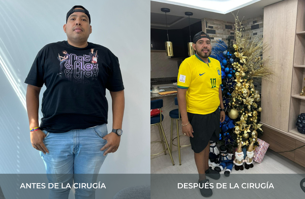 Antes y después de pérdida de peso tras cirugía bariátrica tipo sleeve en Medellín Juan Carlos Gongora