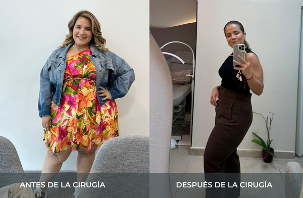 Antes y después de pérdida de peso tras cirugía bariátrica tipo sleeve en Medellín Juan Carlos Gongora