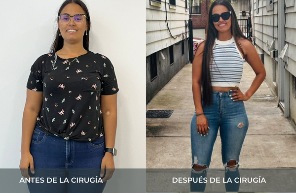 Antes y después de pérdida de peso tras cirugía bariátrica tipo sleeve en Medellín Juan Carlos Gongora