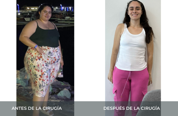 Antes y después de pérdida de peso tras cirugía bariátrica tipo sleeve en Medellín Juan Carlos Gongora