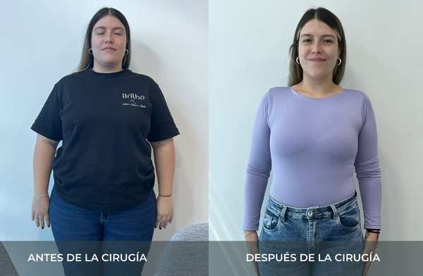 Antes y después de pérdida de peso tras cirugía bariátrica tipo sleeve en Medellín Juan Carlos Gongora