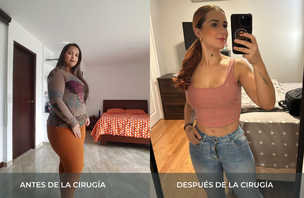 Antes y después de pérdida de peso tras cirugía bariátrica tipo sleeve en Medellín Juan Carlos Gongora