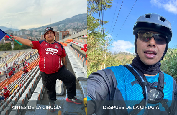 Antes y después de pérdida de peso tras cirugía bariátrica tipo sleeve en Medellín Juan Carlos Gongora
